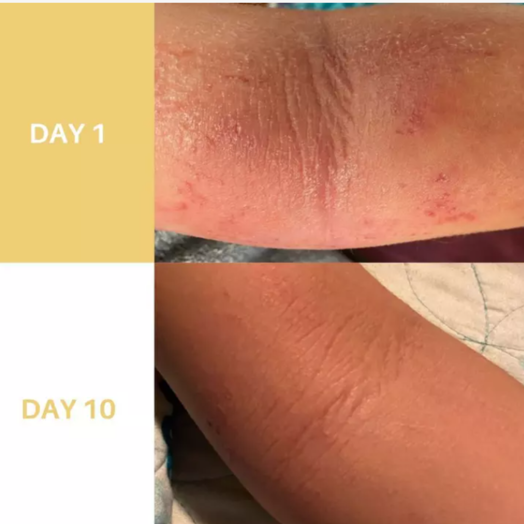 Eczema Relief Balm